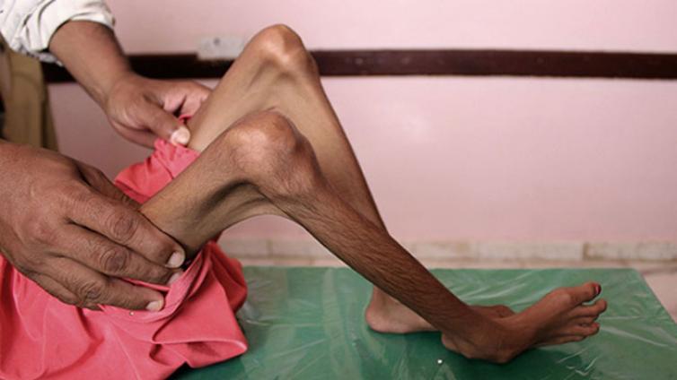 战争 | 也门战争已致8.5万名儿童饿死 统计数据或是“冰山一角”